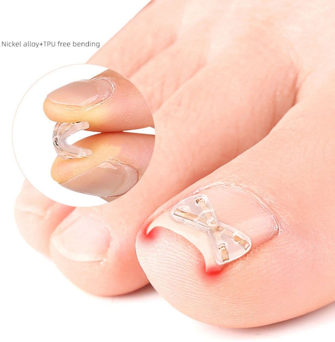 INF Patch papillon pour ongle incarné en X 2 pcs - Alliage de titane, correction invisible de l'orteil Le noir
